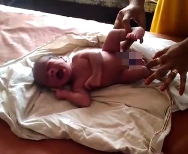 Người dân nhiều nơi đã kéo về TP Gorakhpur, bang Uttar Pradesh, Ấn Độ, để chứng kiến một cậu bé chào đời với 4 chân và 2 bộ sinh dục. Họ rất phấn khích và gọi đây là “phép lạ của Thượng Đế” trong khi bác sĩ cho rằng đây là một ca “sinh đôi ký sinh”.