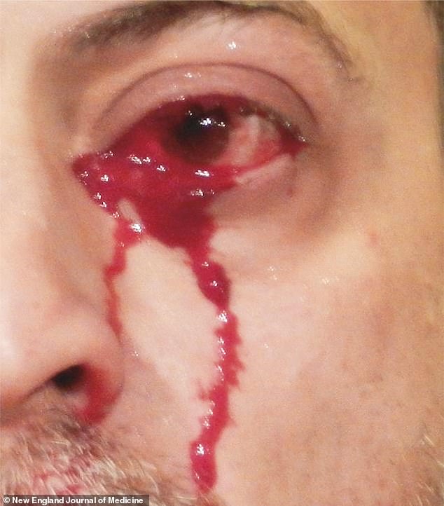 Thay vì khóc ra nước mắt, một người đàn ông 52 tuổi, được giấu tên, đã đến bệnh viện ở TP Messina thuộc Sicily (Ý) để cấp cứu vì khóc ra máu. Đây là chứng bệnh kỳ lạ và hiếm gặp.