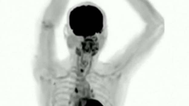 Lần đầu tiên có một chiếc máy “kỳ diệu” như thế, kết hợp hai loại máy chụp phổ biến nhất hiện nay là PET và CT, có thể thăm dò toàn bộ mọi hoạt động của cơ thể người giúp chẩn đoán bệnh nhanh hơn và chính xác hơn. 
